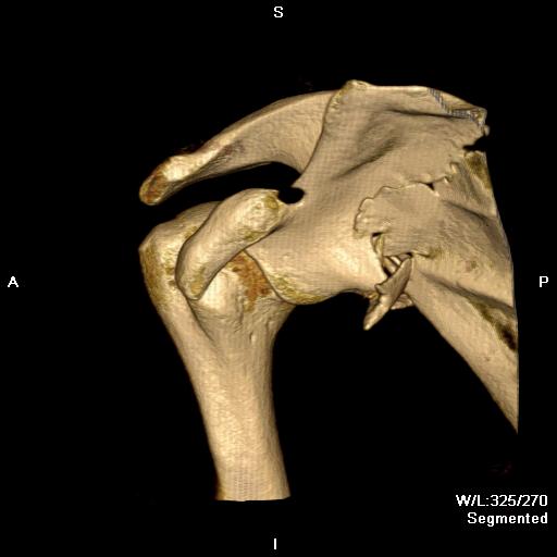 Scapular Blade Fracture CT 2